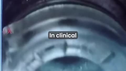 new Al-powered laser surgery make legally blind woman see with 20/20 vision