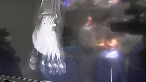 What Surgery On A Foot Looks Like | Orthopedic Surgeon Repairs Talus Fracture | Scott A. Barbour, M.D.