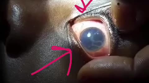 Parasites in eye?