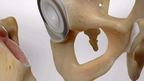 Hip Resurfacing 3D Animation