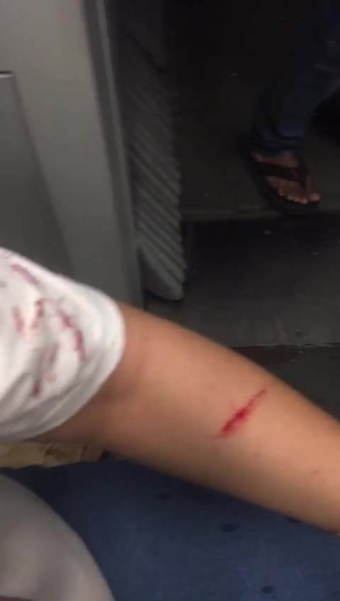 Injured Passengers, LRT Train Believed To Brake Shocking
