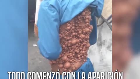 Lo conocen como “el hombre burbuja”