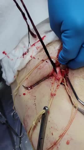 "This Is Not Normal" - Embalmer Richard Hirschman Releases Footage of Unbelievable Blood Clots