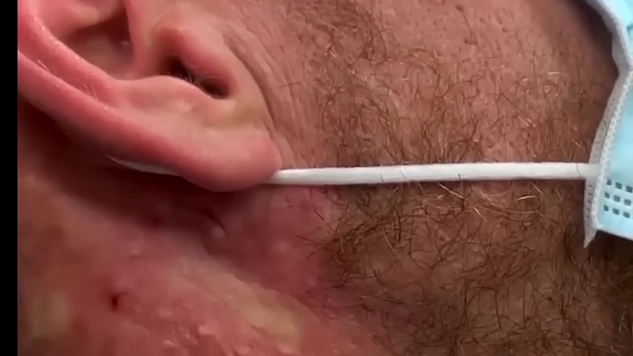 Saucy Blackheads