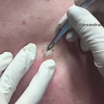 Stuck on YOU! Blackhead on Back