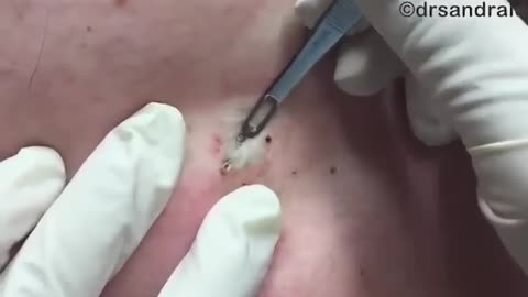 Stuck on YOU! Blackhead on Back