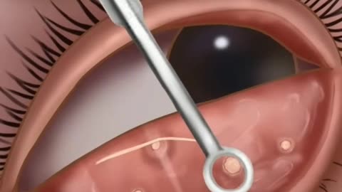 EYE CLEANING ASMR ANIMATION