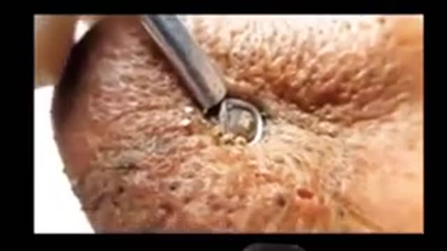 Blackheads Removal From Nose, Satisfying Video, Acne Cleaning