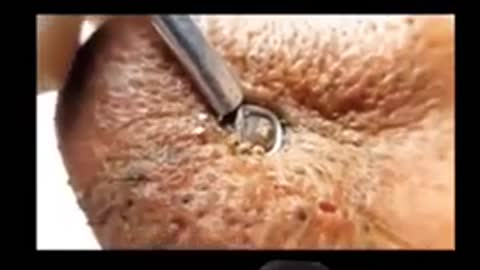 Blackheads Removal From Nose, Satisfying Video, Acne Cleaning