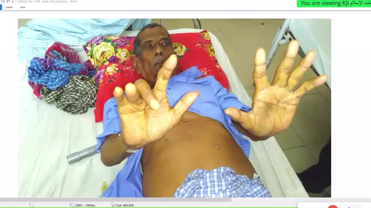 ST5.55-year-old male presented with jaundice