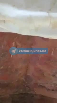 Adverse reaction 💉 after 2nd dose