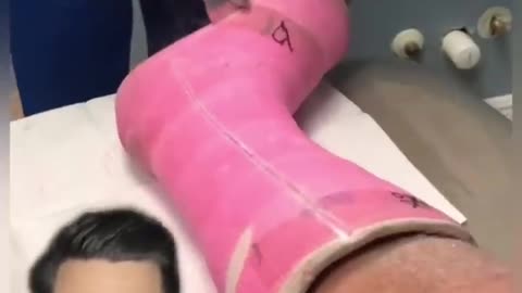 Funny Cast Removal