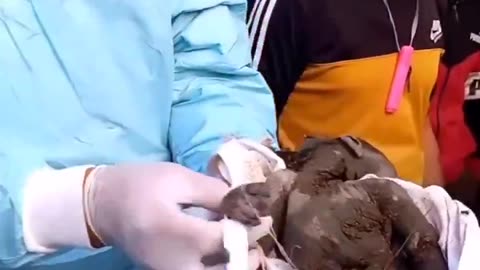 Burned Child in Palestinian genocide