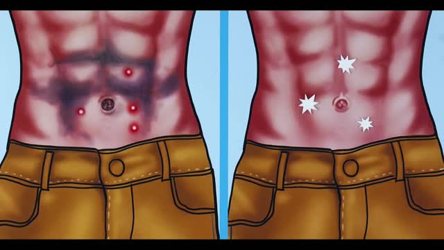 ASMR Navel Cleaning _ Removes Giant Navel Stones and BIG