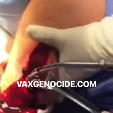 mRNA Blood Clots Removed from Fully Vaxxed - *Graphic*