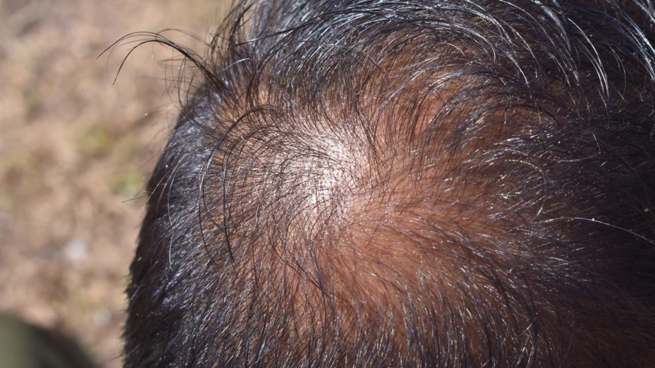 Unlocking the Benefits of Finasteride | Fuzyduck.co