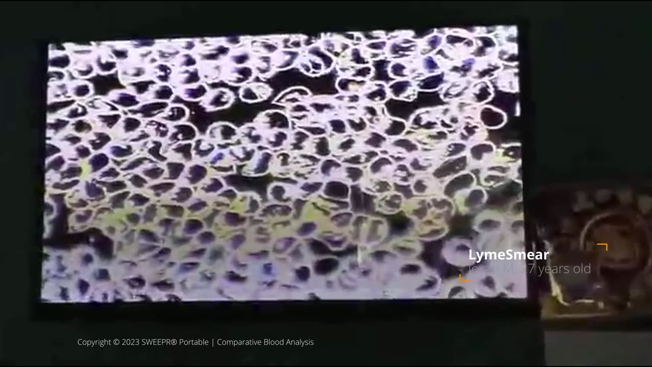 Comparative Blood Microscopy Between Untreated and SWEEPR Treated Individual