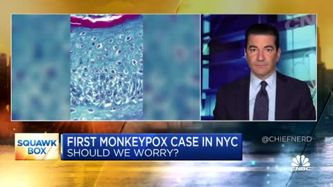 Dr Scott Gottlieb Says Monkeypox is "Particularly Dangerous in Immune Compromised Individuals".