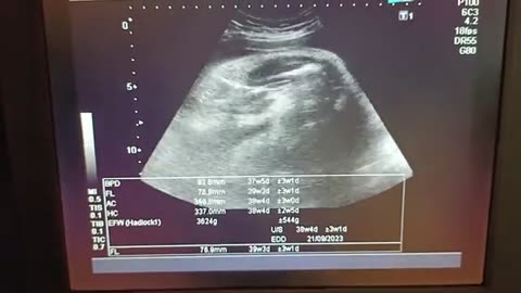 Good Size Baby with Doubtful Gender at 38 Weeks With Adequate Liquor. 😇😇😇
