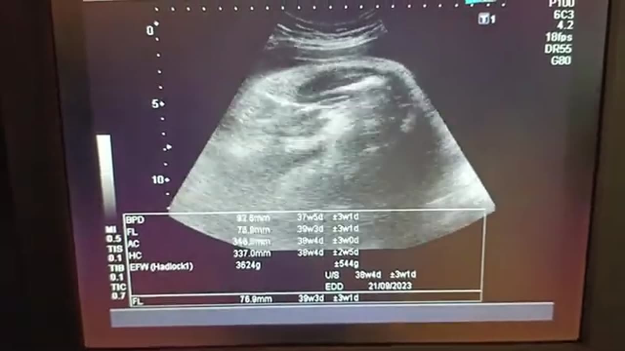 Good Size Baby with Doubtful Gender at 38 Weeks With Adequate Liquor. 😇😇😇