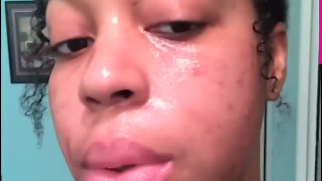 Canadian influencer cures her acne by dropping McDonalds and dairy RealFix