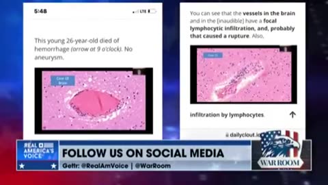 AUTOPSIES CONFIRMED BRUTAL BIOWEAPONS ATTACKS ON MANY ORGANS CAUSED BY THE JABS
