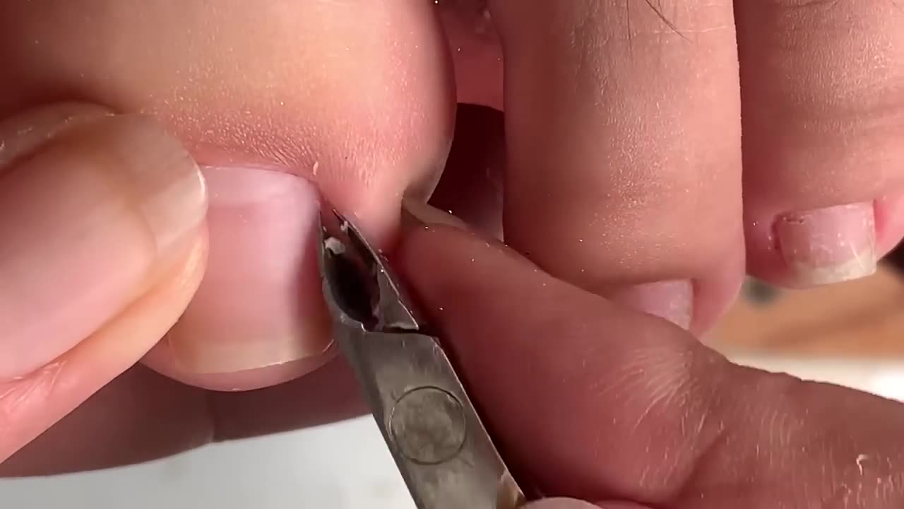 Clean the Skin and remove the corner of the nail#433