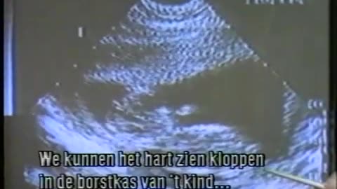 Dit is het derde deel van de video: Weet je wat een geïnduceerde abortus inhoudt? /Nederlands/.MP4