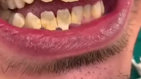 Dental Calculus #tiktok shorts