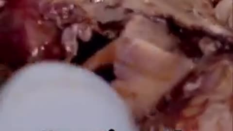 Abortista foi filmado contando como faz para ceifar a vida de bebês inocentes.