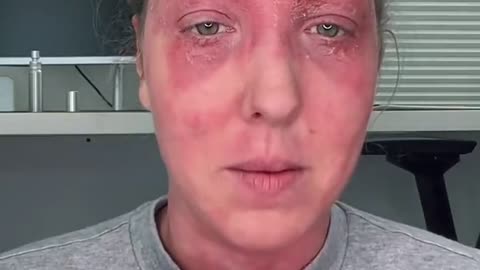 Bad skin reaction to covid vaccine_2022