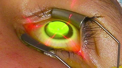 Restore Close-Up Clarity with Advanced Laser Technology
