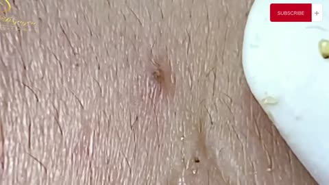 Squeeze blackheads