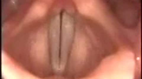 Stroboscopy: Rigid: Normal female vocal cords mid-range