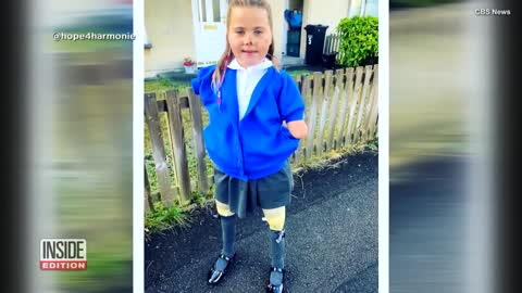 8-Year-Old Girl Gets Computerized Prosthetics