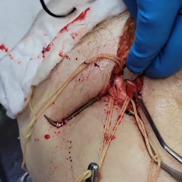 Embalmer: This is not Normal. Footage of Unbelievable Blood Clots
