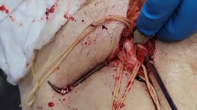 Embalmer: This is not Normal. Footage of Unbelievable Blood Clots