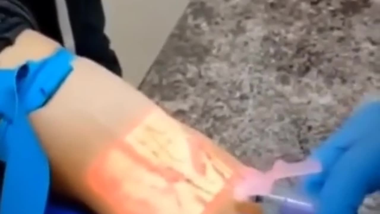 Advance Cannulation Technology !