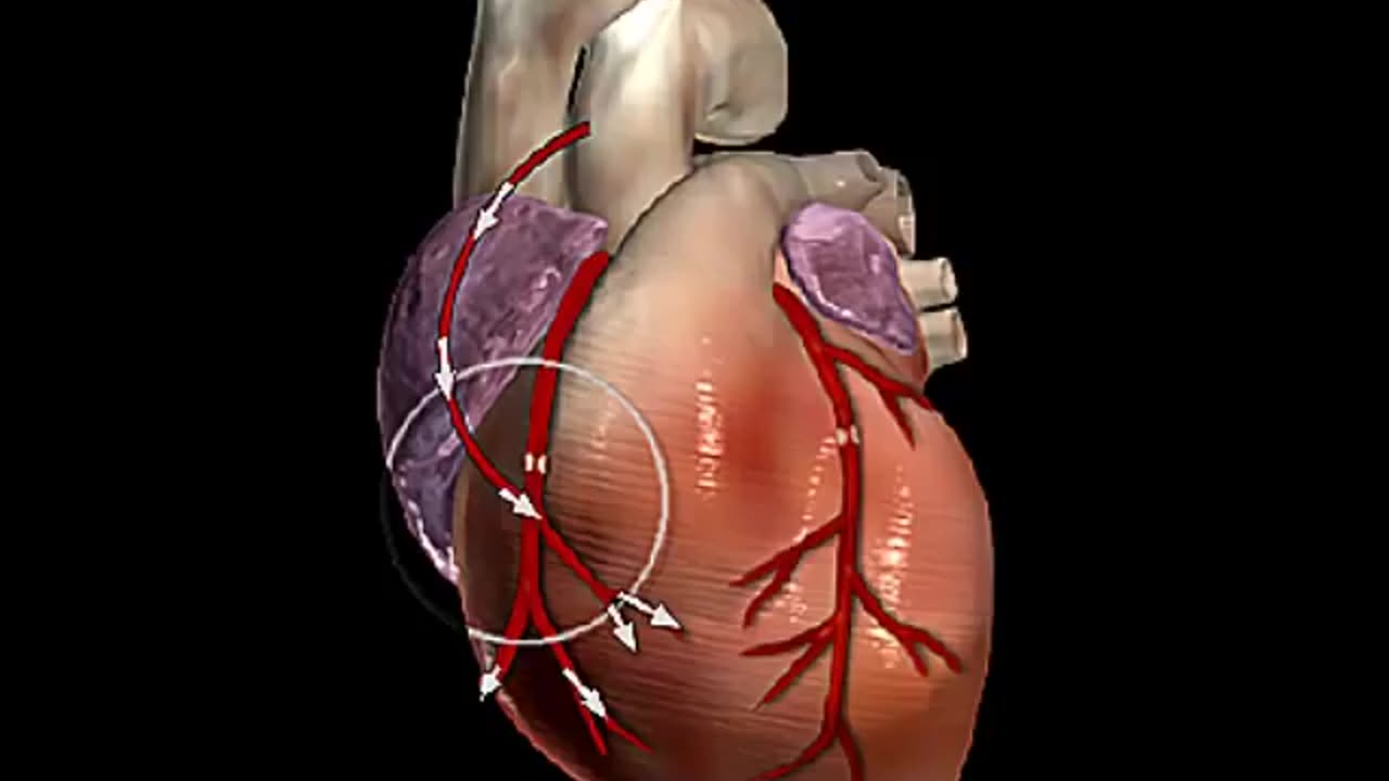 How Does Heart Bypass Surgery Work_ Coronary Artery Bypass Graft Procedure Animation - CABG Video