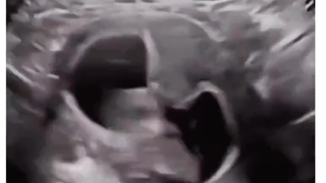 Baby In Womb With Hiccups
