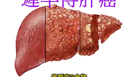 最愛吃3食物 遲早得肝癌