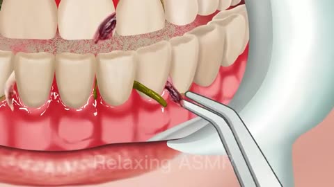 ASMR The best treatment mouth blisters, tonsil stones, swollen gums caused by eating much spicy food