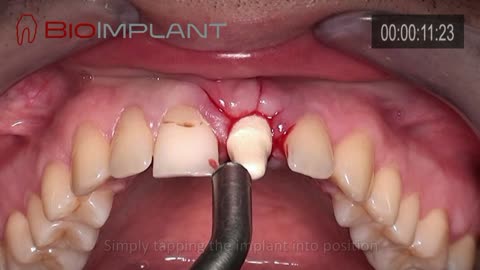 THERE IS ONLY ONE SIMPLE AND LOGICAL WAY AND ENDLESS COMPLICATED ONES TO PLACE AN IMMEDIATE IMPLANT