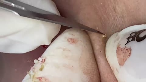 Black Head Removal so Easy