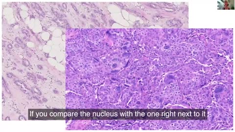 Ute Kruger: COVID vaccination and turbo cancer: pathological evidence with English subtitles