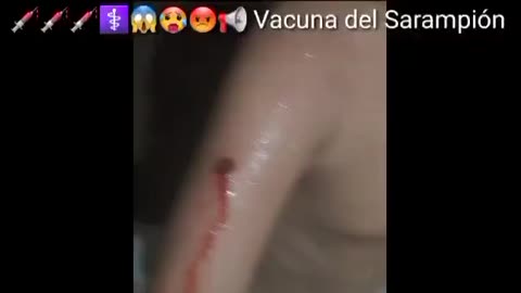 CONSECUENCIAS DE LA VACUNA DEL SARAMPION EN EL BRAZO DE UN NIÑO