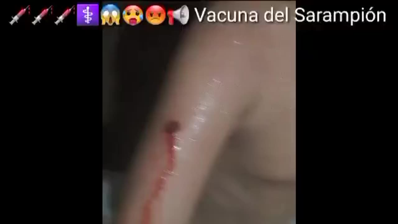 CONSECUENCIAS DE LA VACUNA DEL SARAMPION EN EL BRAZO DE UN NIÑO