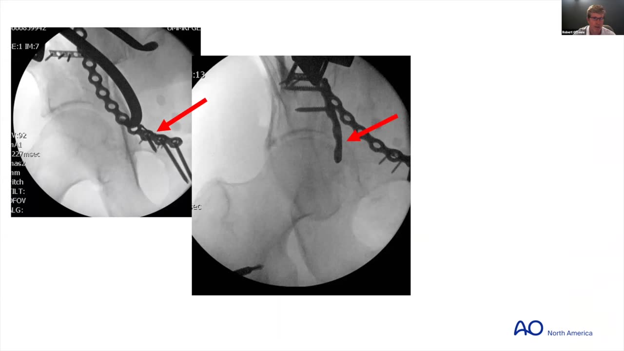 AO North America - Understanding the Anterior Approach & Limitations
