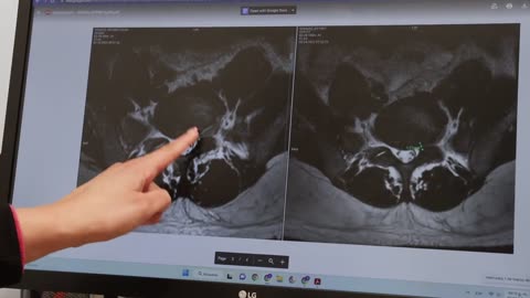 3 Months after Stem Cells for Herniated Disc. How is it Looking?