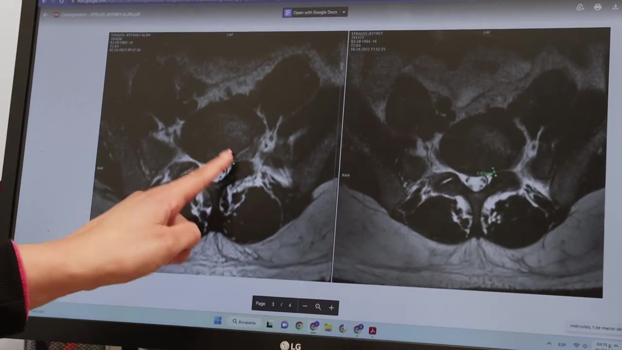 3 Months after Stem Cells for Herniated Disc. How is it Looking?